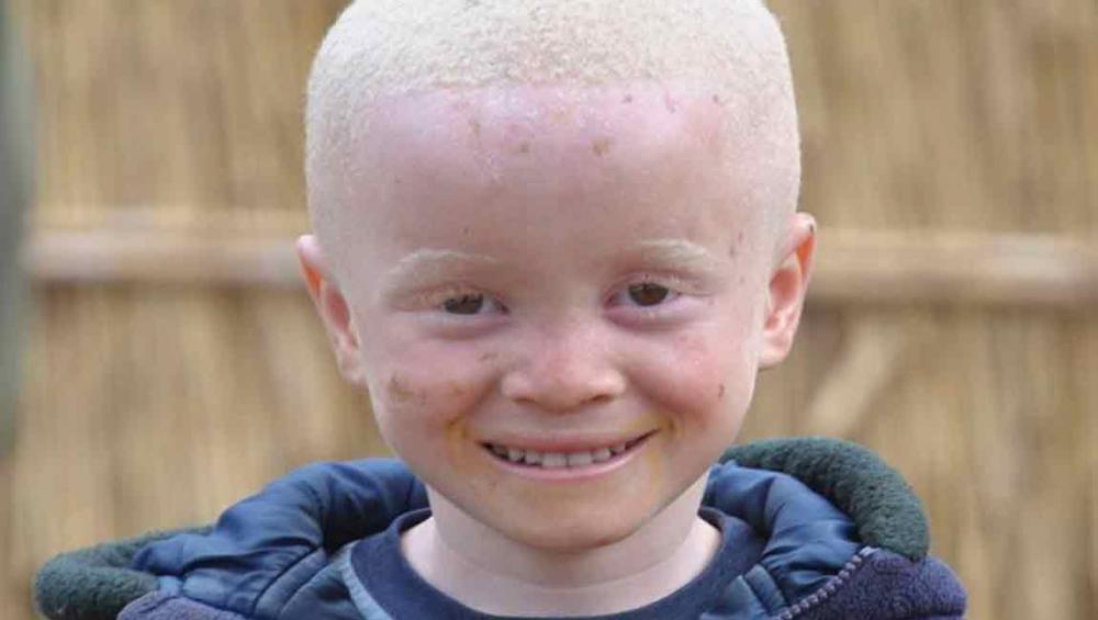 Tanzania: Attacks on persons with albinism decline; local attitudes must change, UN expert finds