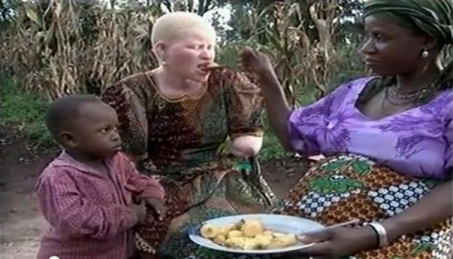 UN hails adoption of African-led resolution on albinism