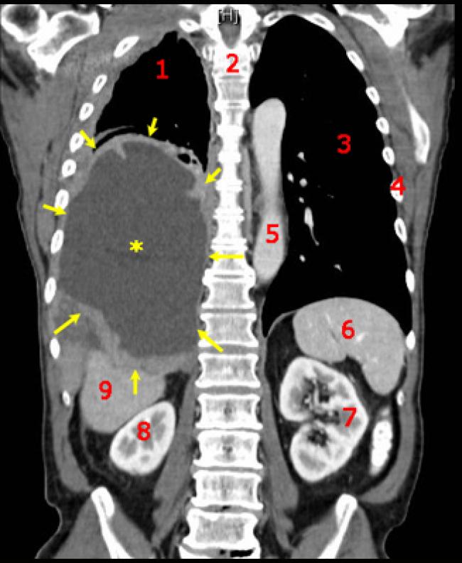 Sensor technology can improve accuracy of prostate cancer diagnosis, research shows