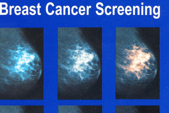 Benefits of mammograms outweigh adverse effects for older women: WHO