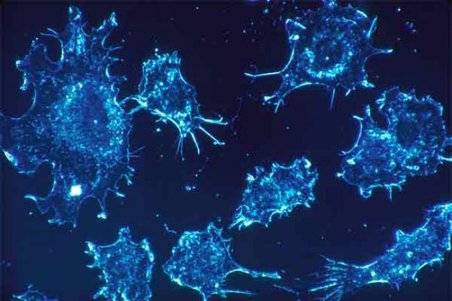 Anal cancer rising worldwide, says study