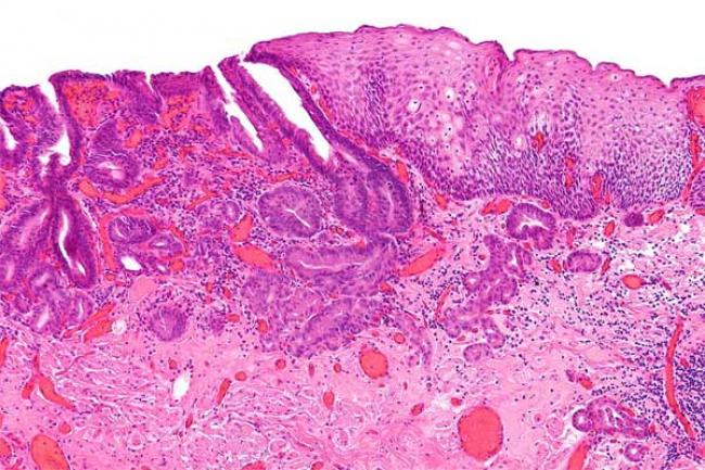 New type of T-cell identified as 'key player' in development of rheumatoid arthritis