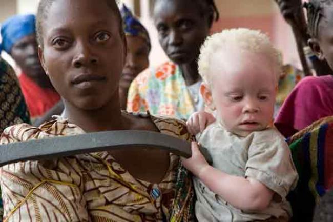UN expert urges greater protection of people with albinism from witch doctors
