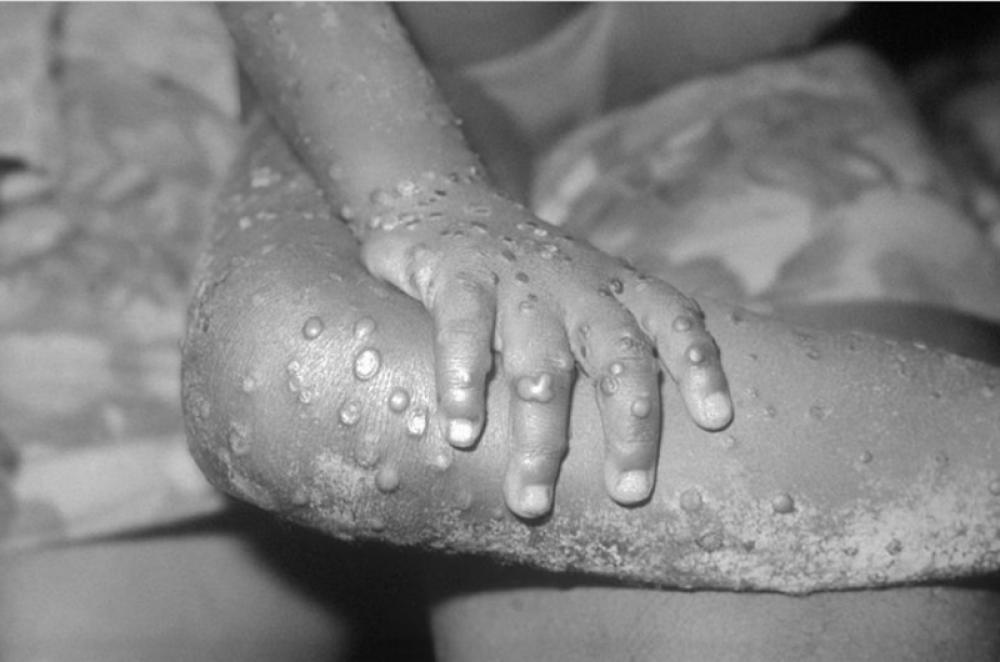 Sweden classifies monkeypox as disease dangerous to society