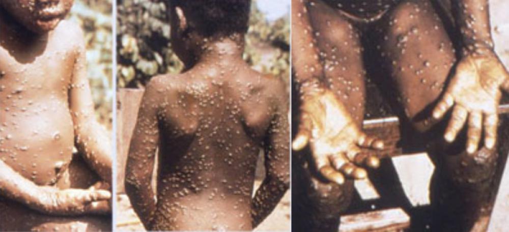 Monkeypox cases spike to 20 in Britain