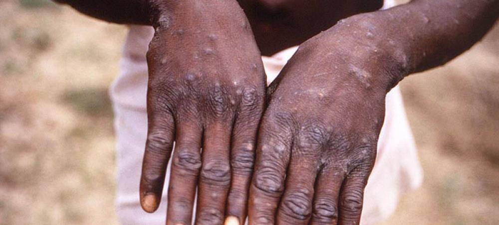 UAE registers first case of Monkeypox