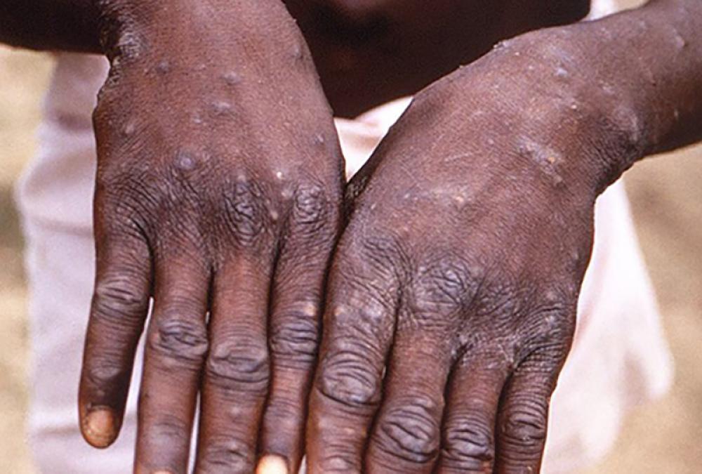 WHO upgrades global monkeypox threat to 