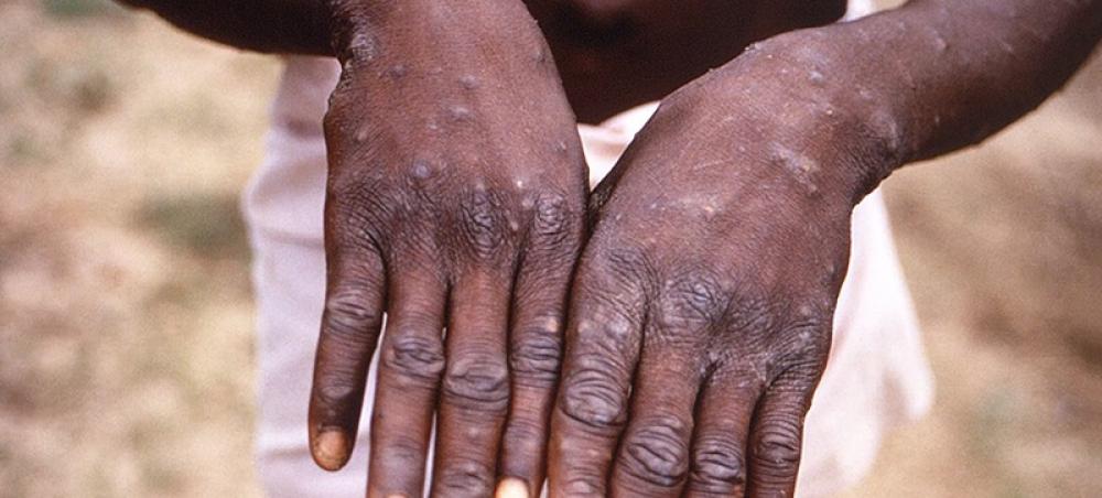  WHO cautions monkeypox spread may not be contained