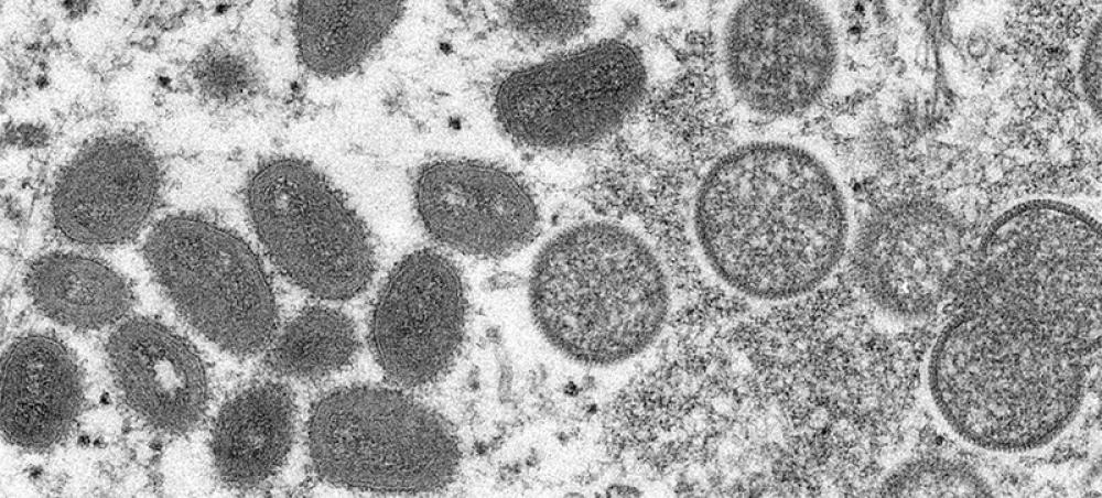Monkeypox: Amid uncertainty, global situation ‘cannot be ignored’ says WHO chief Monkeypox: Amid uncertainty, global situation ‘cannot be ignored’ says WHO chief