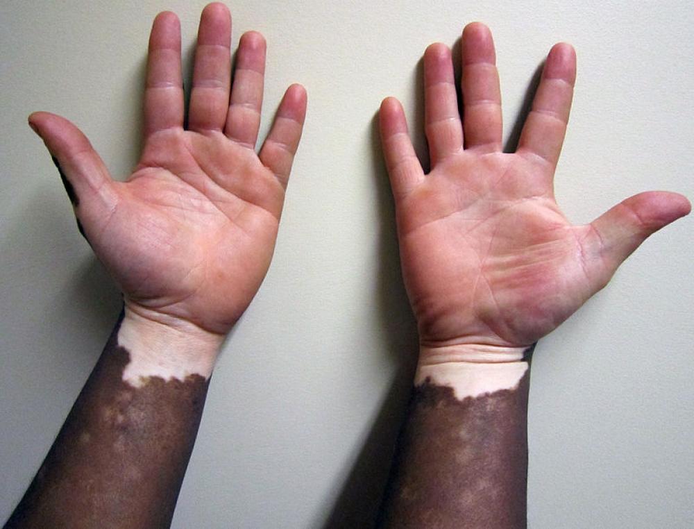 Vitiligo: Controversial skin cream may soon arrive in UK 