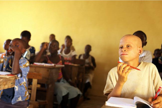 Surge in vicious attacks on albino children in East Africa: UN