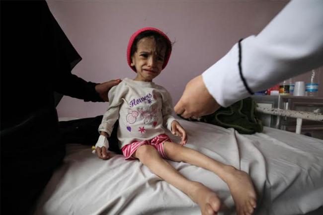 Over 500 children dead, 1.7 million at risk of malnutrition owing to Yemen violence: UN