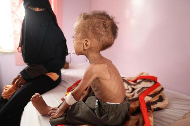 More than half a million children now risk malnutrition in Yemen: UNICEF